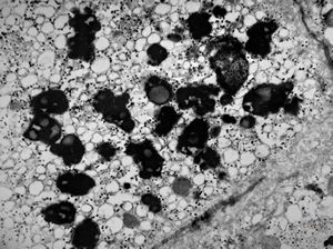 M,17y. | increased amount of lipofuscin in hepatocyte - hyperbilirubinemia, Gilbert or Dubin-Jones syndrome